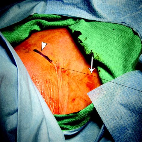 Ct Guided Hookwire Placement A Technical Innovation For Preoperative