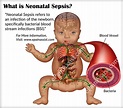 What is Neonatal Sepsis? | Sepsis, Neonatal, Neonatal nurse