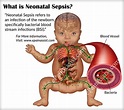 What is Neonatal Sepsis? | Sepsis, Neonatal, Neonatal nurse