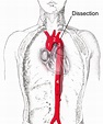 Aortic dissection - Wikipedia