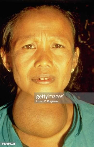 Goiter Stock Photos And Pictures Getty Images