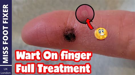 Wart On Finger Full Treatment After Treatment Updates Too By