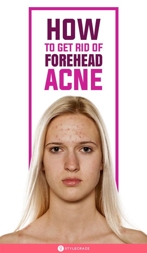 How To Get Rid Of Pimples On Forehead Forehead Acne Pimples On