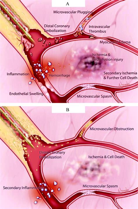 Microvascular Obstruction And The No Reflow Phenomenon After