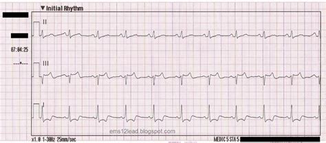 Ems 12 Acute Stemi Mimic Case Jems Ems Emergency Medical