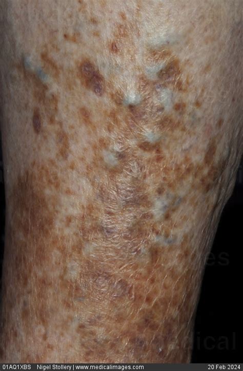 Stock Image Dermatology Hemosiderin Deposits A Spread Of Yellowish