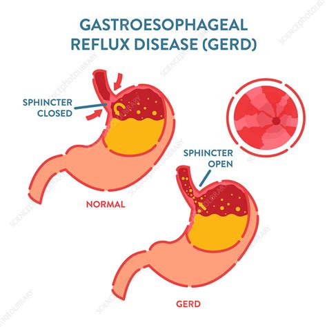 Gastroesophageal Reflux Disease Illustration Stock Image F033 6077