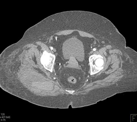Right Gluteal Hematoma In A Patient With Fatty Liver Disease