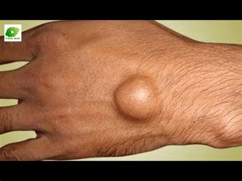 How to Dissolve Ganglion - Calcium Deposits - YouTube