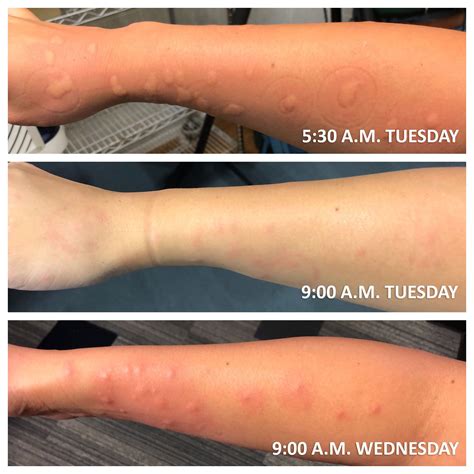 Bed Bug Bites Vs Mosquito Bites Updated With Pictures My Xxx Hot Girl
