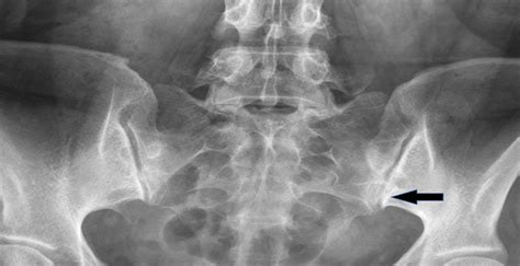 The Accessory Sacroiliac Joint Diagnosed With Bone Spectct Clinical