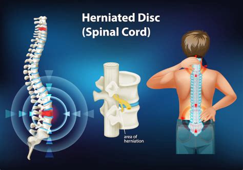 What Are The Symptoms And Causes Of Slipped Herniated Disk