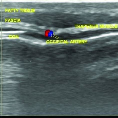 Pdf Ultrasound Guided Greater Occipital Nerve Blocks And Pulsed