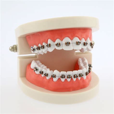 Braces Round Rock Dentist Nuyu Dental