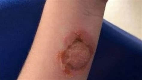 Spider Bite Leaves Girl Hospitalised As Seven Year Olds Skin Eaten