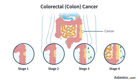 Colorectal Cancer Symptoms Stage