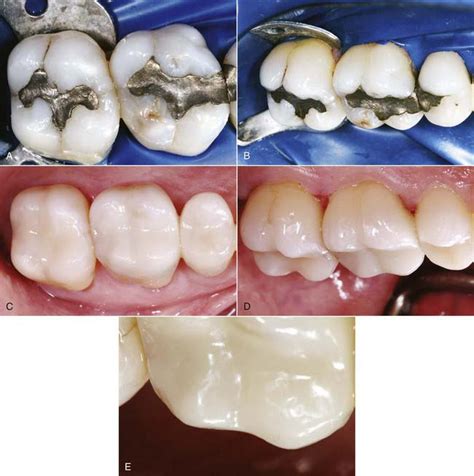 10 Posterior Direct Composites Pocket Dentistry