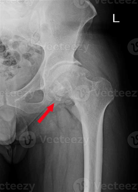Esclerose No Teto Acetabular