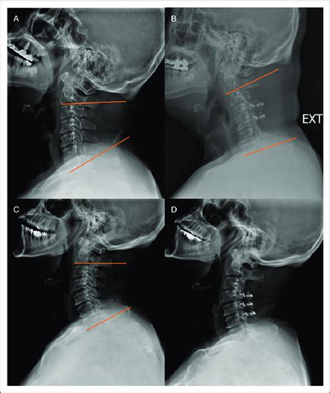 Two Patients Who Underwent Cervical Laminoplasty Including C3