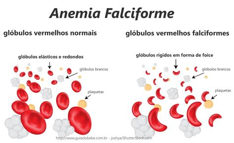 Anemia Falciforme Guia Do Bebê