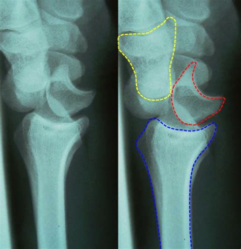 Perilunate Dislocation The Bmj