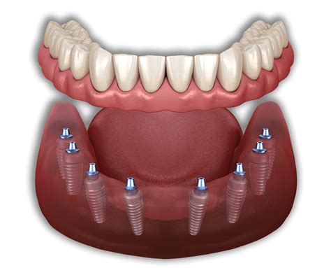 All On 8 Dental Implants in Mexico - Lifetime Guarantee