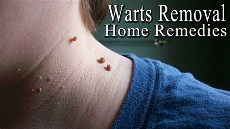 Warts 5 Simple Home Remedies To Get Rid Of Facial Warts Naturally