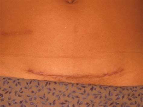 Img3479 Rs Post Op Scar Look From Her 61109 Laparotomy Flickr