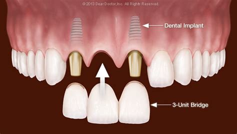 dental bridge vs implant smile place dental