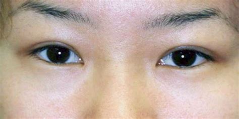Dr Archie Lamb Asian Double Eyelid Surgery
