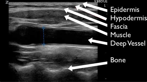 Pocus For Soft Tissue Cellulitis Abscess Nec Fasc Foamed Foamus