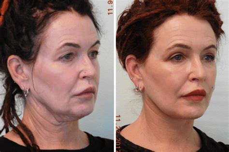 How Much Does A Neck Lift Cost Las Vegas Neck Lift The Lanfranchi