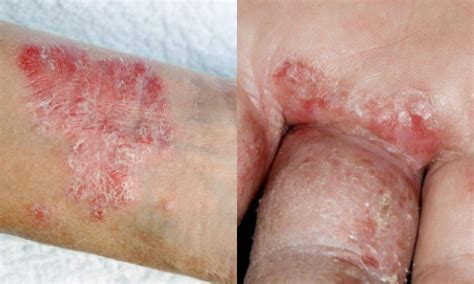 Types Of Eczema Atopic Contact Seborrheic Dyshidrotic And Stasis