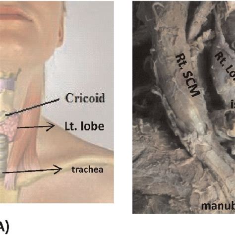 A Diagram Showing Right And Left Lobe Of Thyroid Gland Along With
