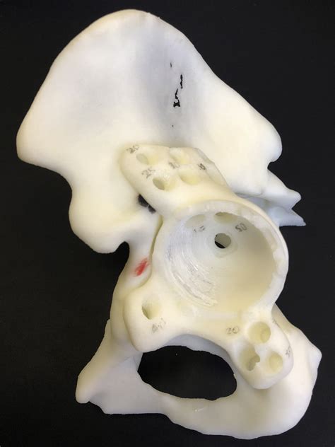 Survivorship And Clinical Outcomes Of Custom Triflange Acetabular