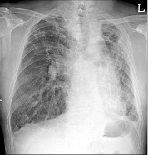 Chest X Ray On The First Day At The Hospital Shows Increased Opacity In