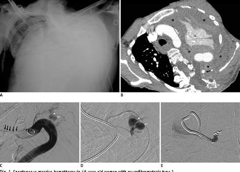 Figure From Spontaneous Massive Hemothorax In A Patient With