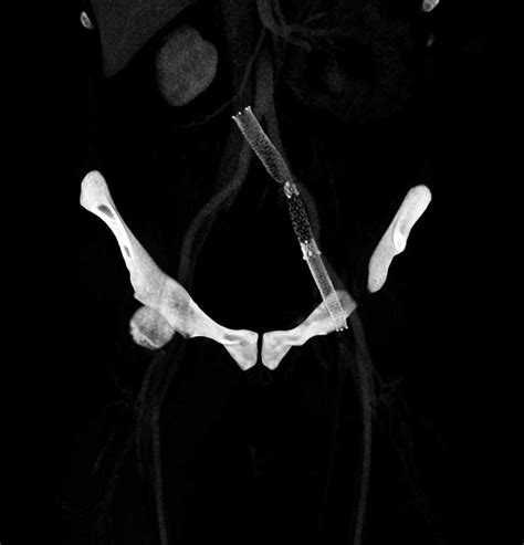 Stent In Left Common Iliac Artery In Patient With May Thurner Syndrome