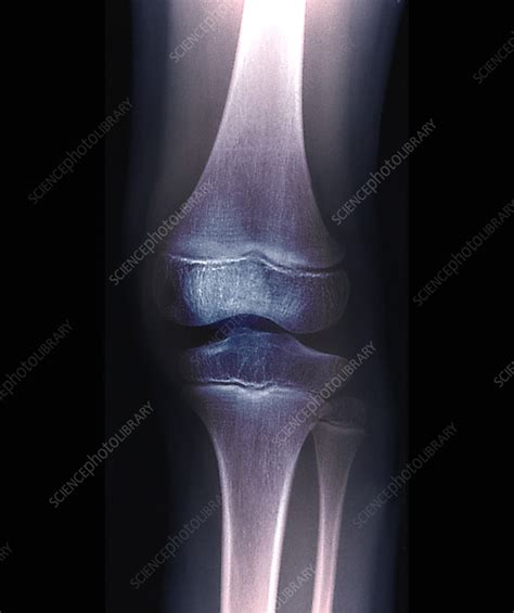 Normal Knee Of A Child X Ray Stock Image C0551188 Science Photo