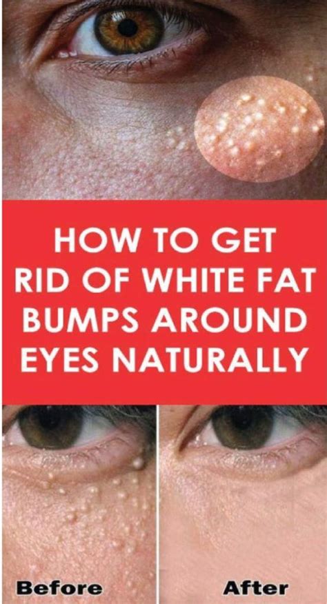 Milia How To Remove The Small White Skin Cysts In 2020 Skin Care