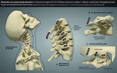 Atlantoaxial Instability Cervical Diagnosis Spine Surgery