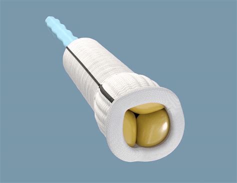 Edwards Konect Resilia Aortic Valved Conduit Wins Fda Approval For Bio