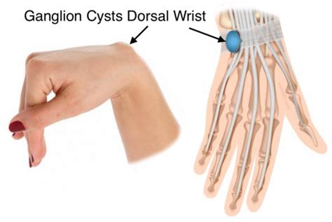 Ganglion Cyst Dorsal Wrist Fort Worth