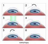 Wikipedia Lasik Eye Surgery