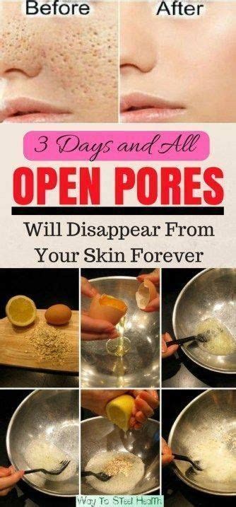 How To Get Rid Of Enlarged Pores Naturally Skin Care Health Skin