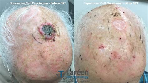 Tareen Dermatology Superficial Radiotherapy Skin Cancer Treatment