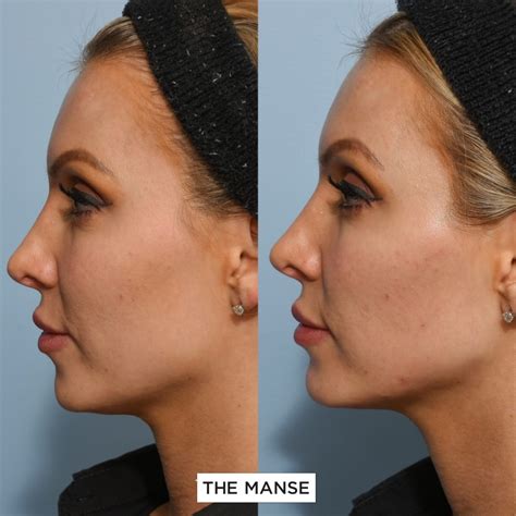 Jawline Definition Injections Best Clinic Sydney For Dermal Fillers