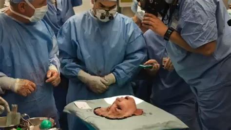 Face Transplant How Surgeons Graft A Dead Donors Face On A Living Recipient In This