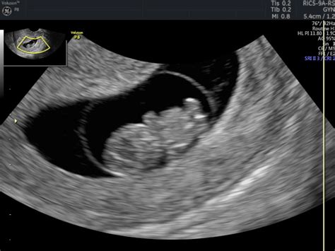 Early Pregnancy Scan Private One On One Pregnancy And Fertility