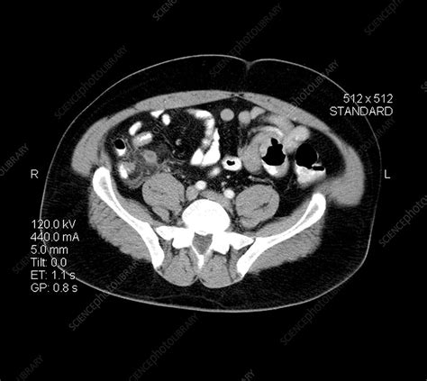 Ct Of Acute Appendicitis Stock Image M1080724 Science Photo Library
